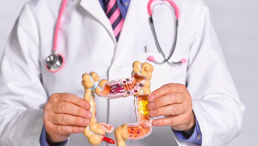 rettocolite ulcerosa