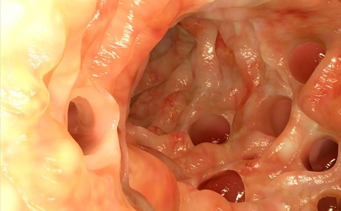 diverticoli