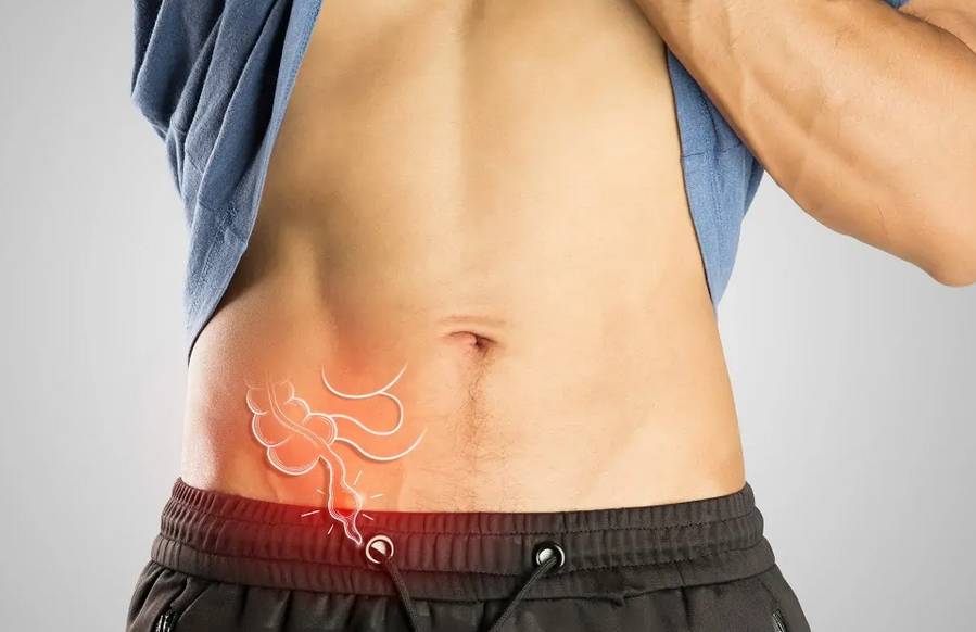 diverticolite peritonite